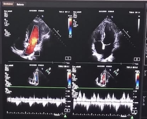Ecocardiogramma del cuore in ambulatorio cardiologico a Genova Ecocardiogramma cardiaco con immagini ecografiche del cuore a Genova